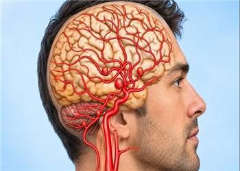 AI و افزایش 40 درصدی موفقیت رادیولوژیستها در شناسایی «ضایعات عروقی مغز»